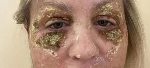 Une femme défigurée après des injections pour réduire les rides...