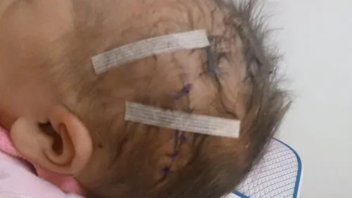 Un bébé blessé par un coup de scalpel pendant une césarienne