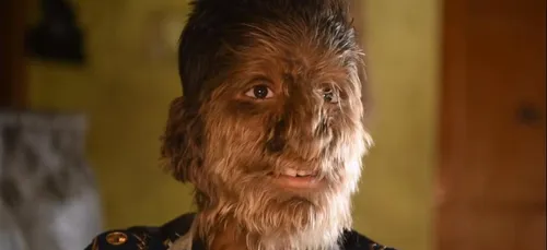 Ce garçon est atteint du syndrome du loup-garou