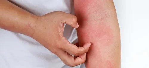 Pourquoi ça gratte ?