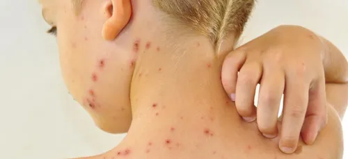 Une épidémie de varicelle touche les Hauts-de-France