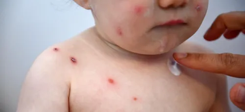 L'épidémie de varicelle se poursuit dans les Hauts-de-France