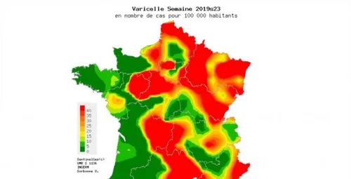 Une épidémie de varicelle touche les Hauts-de-France