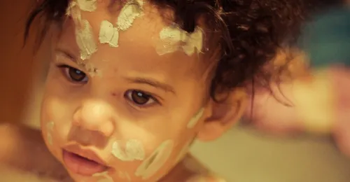 Regain de cas de varicelle dans l'Aisne et en Champagne-Ardenne