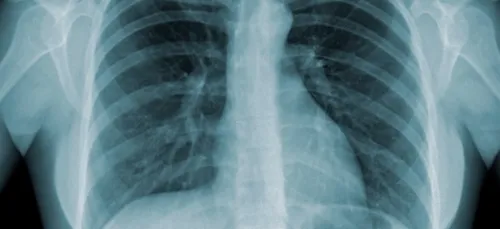 Poitou-Charente : des élèves dépistés suite à un cas de tuberculose