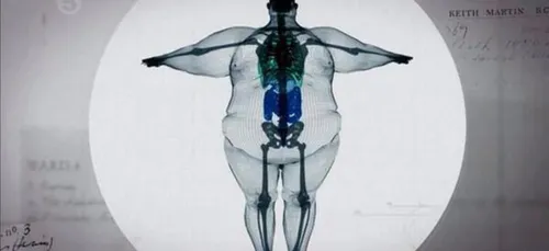 Le nombre de jeunes obèses augmente !