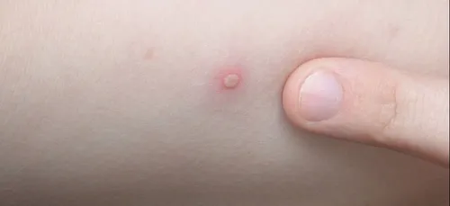 La varicelle est de retour pour nous jouer un mauvais tour