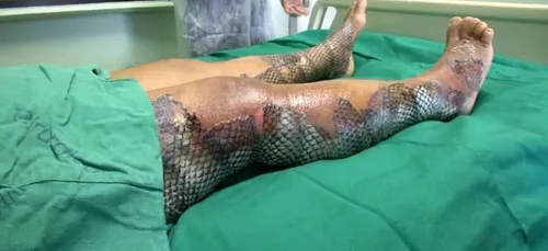 Au Brésil, de la peau de poisson pour soigner les brulés !