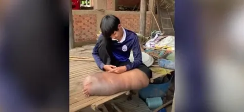 Piqué par des moustiques, sa jambe gonfle et devient cinq fois plus...