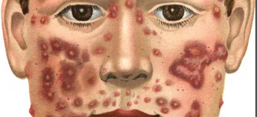 Cake Scape: un gâteau pour éclater les boutons d'acné et les manger...