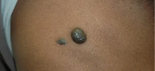 Comment savoir si un grain de beauté est suspect ?