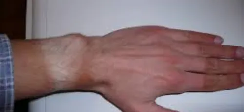 La Bretagne, région la plus touchée par les mélanomes