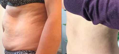 Château-Gontier : maigrir par... le froid ?