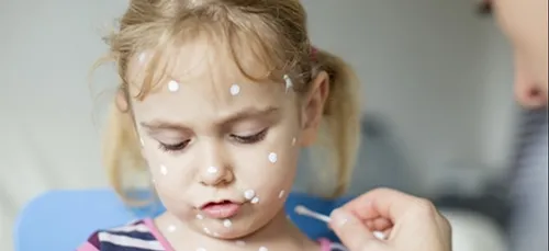 Varicelle : un pic en Pays-de-la-Loire