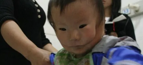 Une malformation rare dédouble le visage de cet enfant ! (photos)