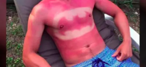 Attention danger ! :  le SunBurn Art, les coups de soleil qui...