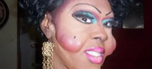 Quand la chirurgie esthétique va trop loin... (photos)