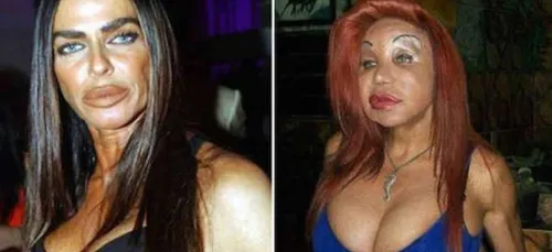 Comble de l'horreur : Ces gens ont trop forcé sur la chirurgie...