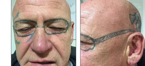Bourré il se tatoue une paire de lunettes sur le visage ! (photos)