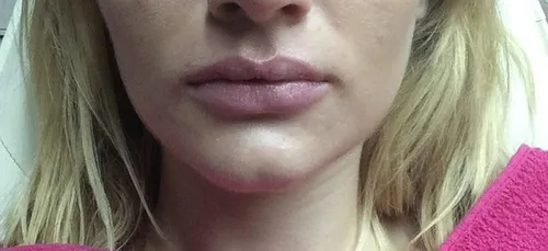 Massacre: une opération de chirurgie esthétique pour avoir des...