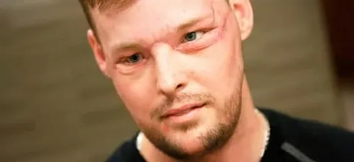 Découvrez l'incroyable greffe du visage qu'a subi cet homme ! (Vidéo)