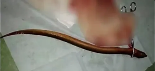 A la faveur d'un jeu sexuel, cet homme s'est inséré une anguille...