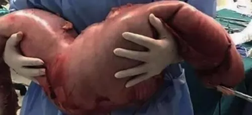 Constipé depuis sa naissance, cet homme se fait enlever 13 kilos...