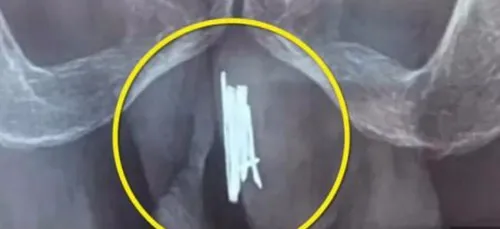 Pour le kiff, cet homme s'insère 15 aiguilles à coudre dans...