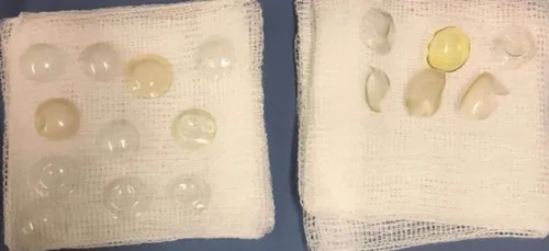 Cette chirurgienne retrouve 27 lentilles de contacts dans les yeux...