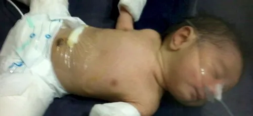 En Inde, un bébé est enceinte de son jumeau !