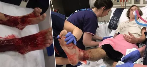 Un jeune australien se fait dévorer les jambes par des "puces de...