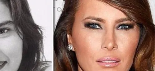 Melania Trump aurait dépensé 16.000 dollars en chirurgie...