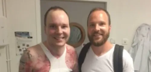 Brûlé à 95 %, il est finalement sauvé grâce à son frère jumeau qui...
