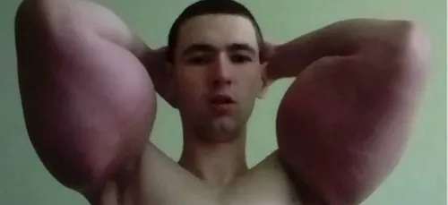 Afin de ressembler à Popeye, il s'injecte de l'huile dans les...