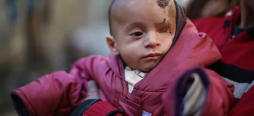 Éborgné après un raid aérien, un nourrisson Syrien devient un...