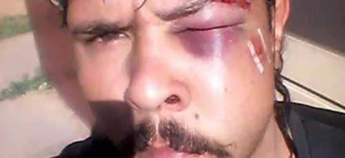 Il se casse la mâchoire après s'être pris le derrière d'un kangourou !