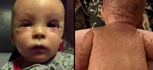 Le cannabis soigne un enfant qui ressemblait à un poisson à cause...