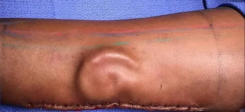 Une militaire se fait greffer une oreille, implantée au préalable...