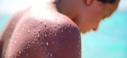 Une astuce pour apaiser les coups de soleil fait le buzz ! (photo)