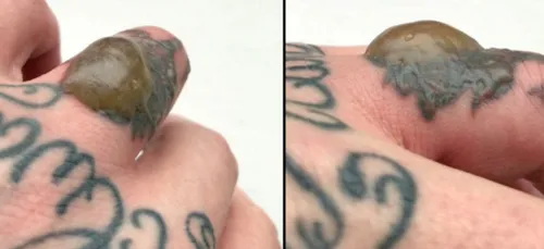 Il développe une immonde verrue après avoir tenté d'effacer son...