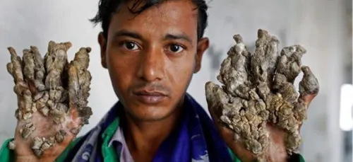 Homme-arbre : il va bientôt se faire opérer, sa condition s'aggrave !