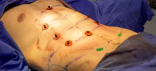 La chirurgie des abdos, pour des tablettes parfaites !