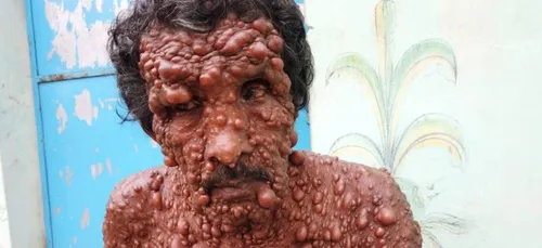 Recouvert de tumeurs, cet indien vit un véritable enfer [PHOTO]
