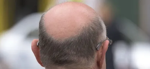 Vous perdez vos cheveux ? Faites-les vous tatouer ! (photos)