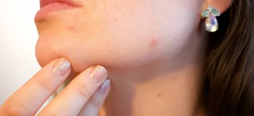 Ceux qui ont souffert d'acné ont un avantage considérable !