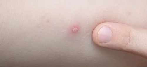 La varicelle gagne du terrain dans le Limousin et en Centre-Val de...