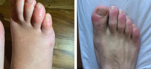 Un nouveau symptôme du Coronavirus, découvert par les dermatologues