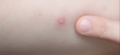 La varicelle est de retour pour nous jouer un mauvais tour