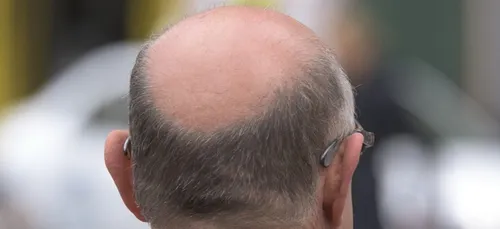 Vous perdez vos cheveux ? Faites-les vous tatouer ! (photos)