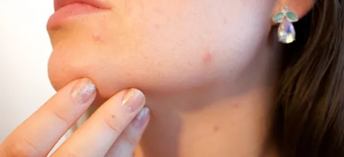Ceux qui ont souffert d'acné ont un avantage considérable !